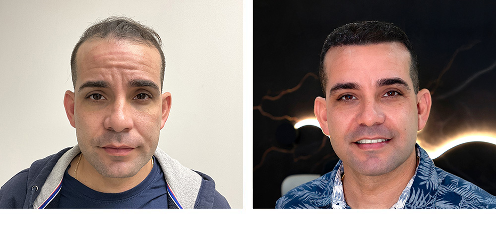 Hair Transplant Before and after in Miami