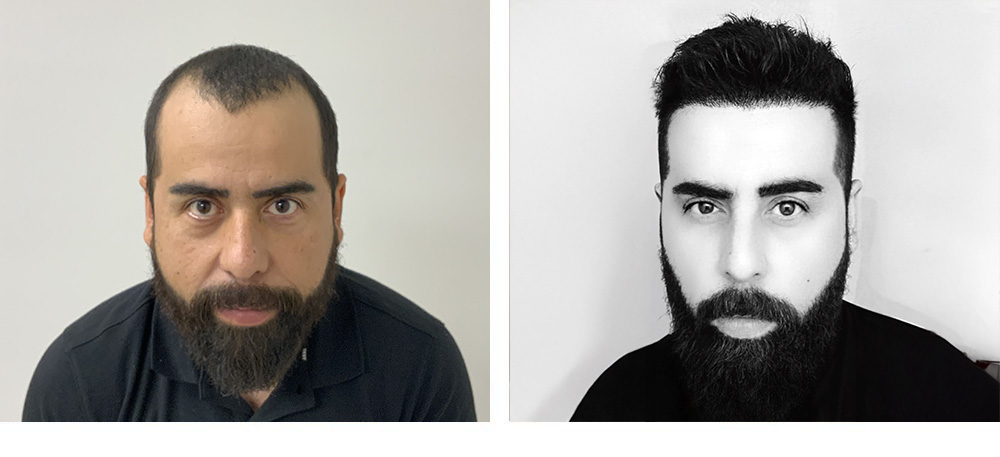 Hair Transplant Before and After
