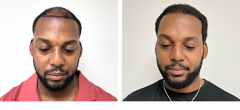 Hair Transplant Before and After