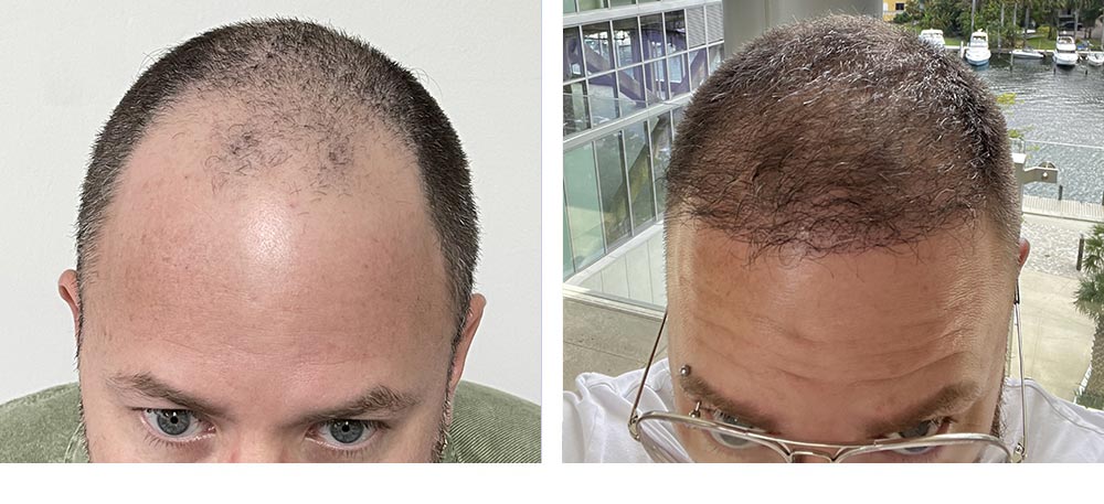 Hair Transplant Before & After Photo Gallery | Care4Hair