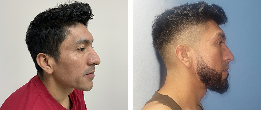 Beard hair transplant before and after