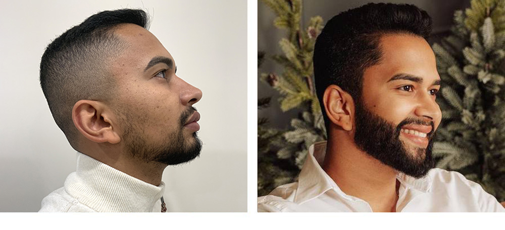 Beard Restoration Before and After in Miami