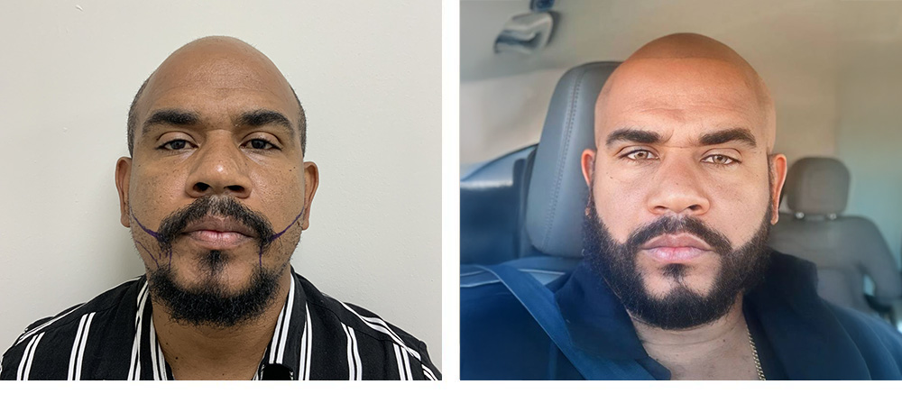 Beard Hair Transplant Before and After
