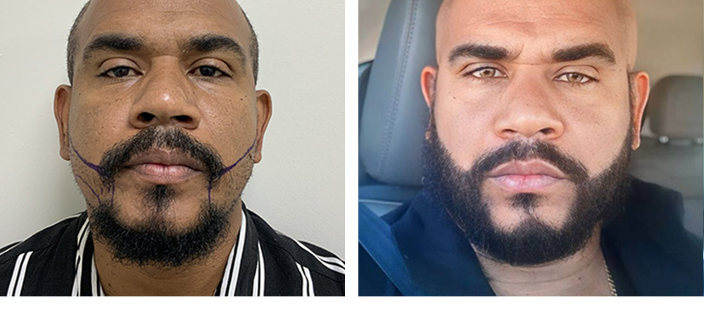 Beard Hair Transplant Before and After