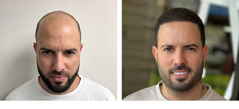 Hair Transplant Before and After