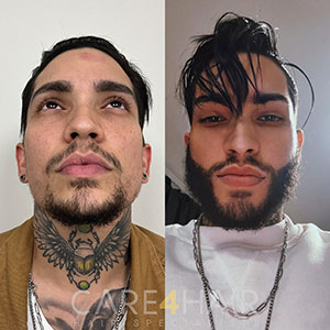 Allan Beard Transplant before and after