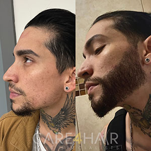 Allan Beard Transplant before and after