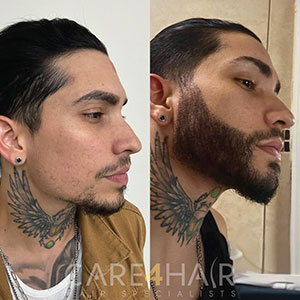 Allan Beard Transplant before and after