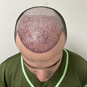 angel hair transplant 1 day after surgery