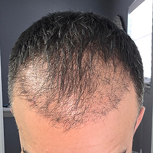 angel hair transplant 3 month after