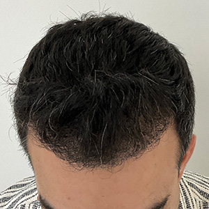 angel hair transplant 6 months after