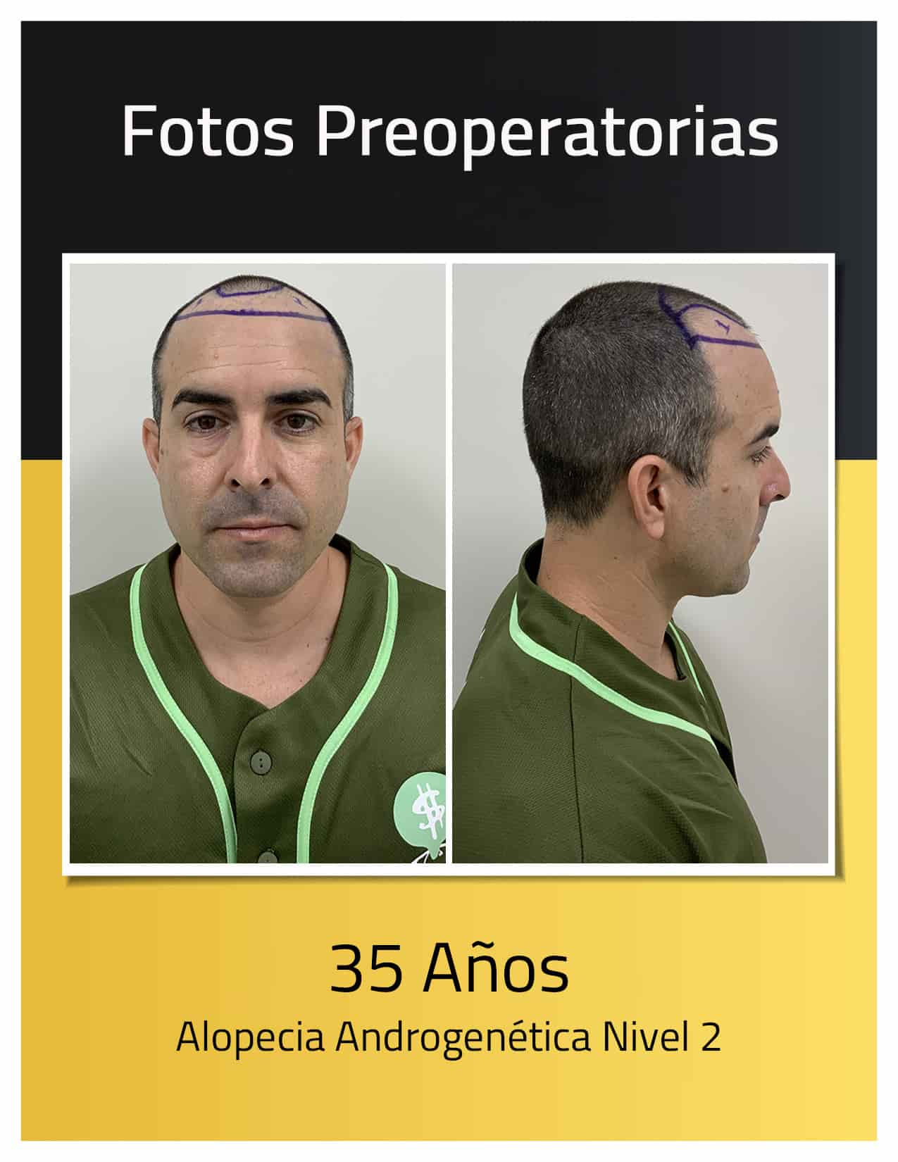 Fotos preoperatorias del trasplante de cabello de Angel Hidalgo