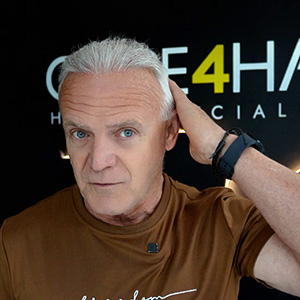 carlos calero Hair Restoration 10 Months After