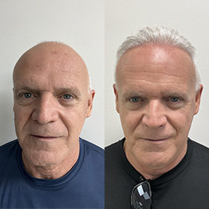 carlos calero and His Hair Restoration Front View