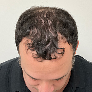 Eduardo Frómeta before hair transplant