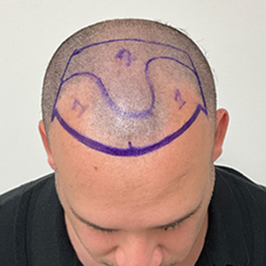 Eduardo Frómeta hair transplant surgery day