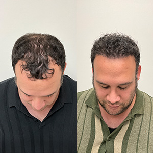 Patient Eduardo Frómeta hair transformation before and after front view