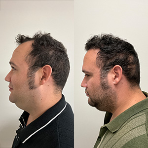 Patient Eduardo Frómeta hair transformation before and after left view