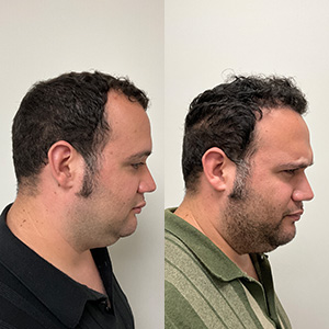 Patient Eduardo Frómeta hair transformation before and after right view