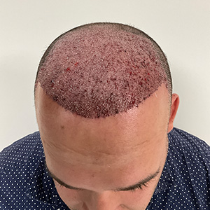 Eduardo Frómeta hair transplant 1 day after surgery
