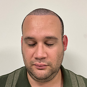 Eduardo Frómeta hair transplant 1 week after