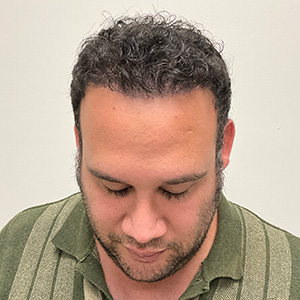 Eduardo Frómeta hair transplant 6 months after