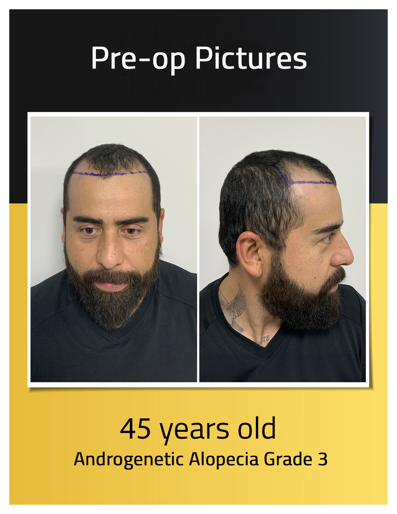 Fotos preoperatorias del trasplante de cabello de Angel Hidalgo