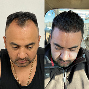 Enmanuel Larios y su restauración capilar hacia abajo