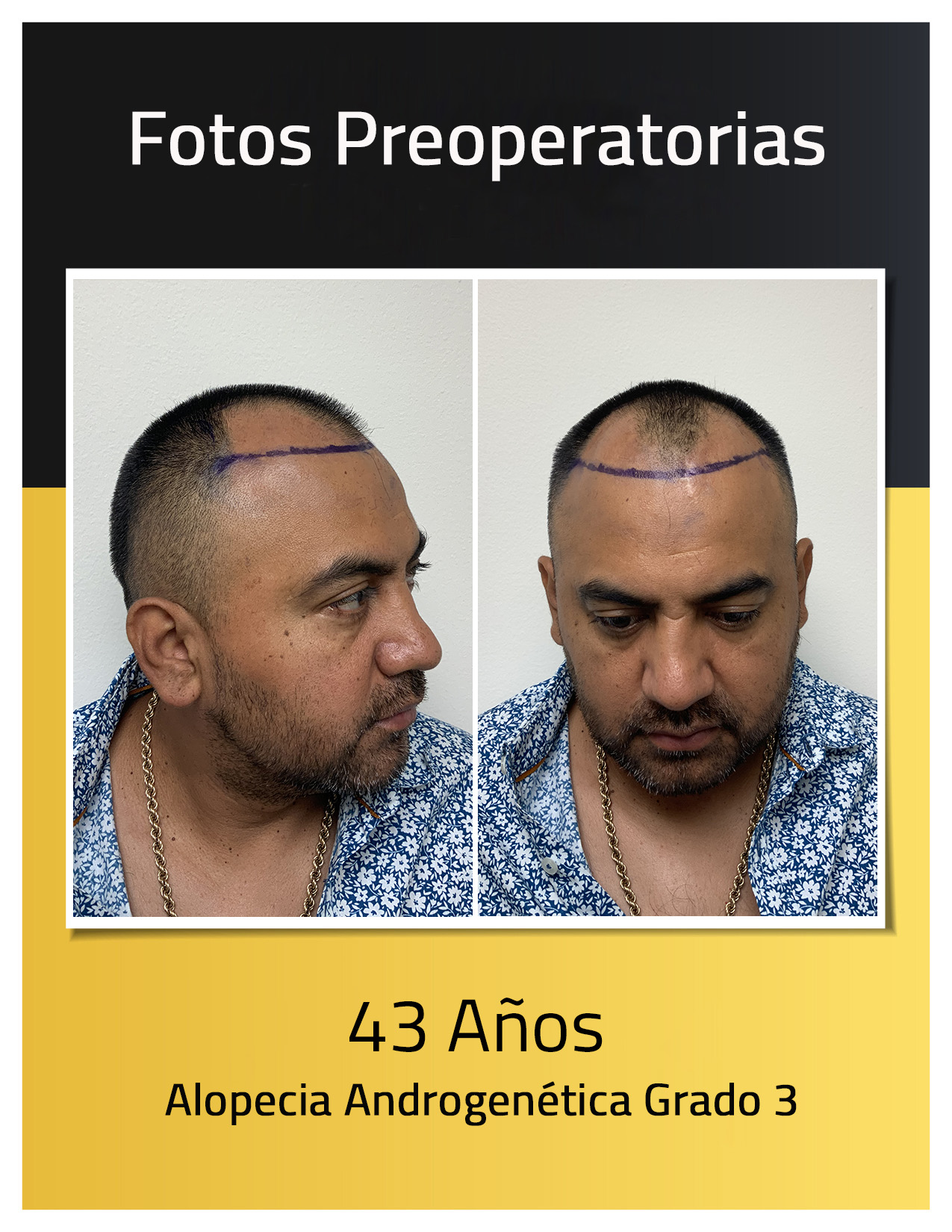 Fotos preoperatorias del trasplante de cabello de Angel Hidalgo