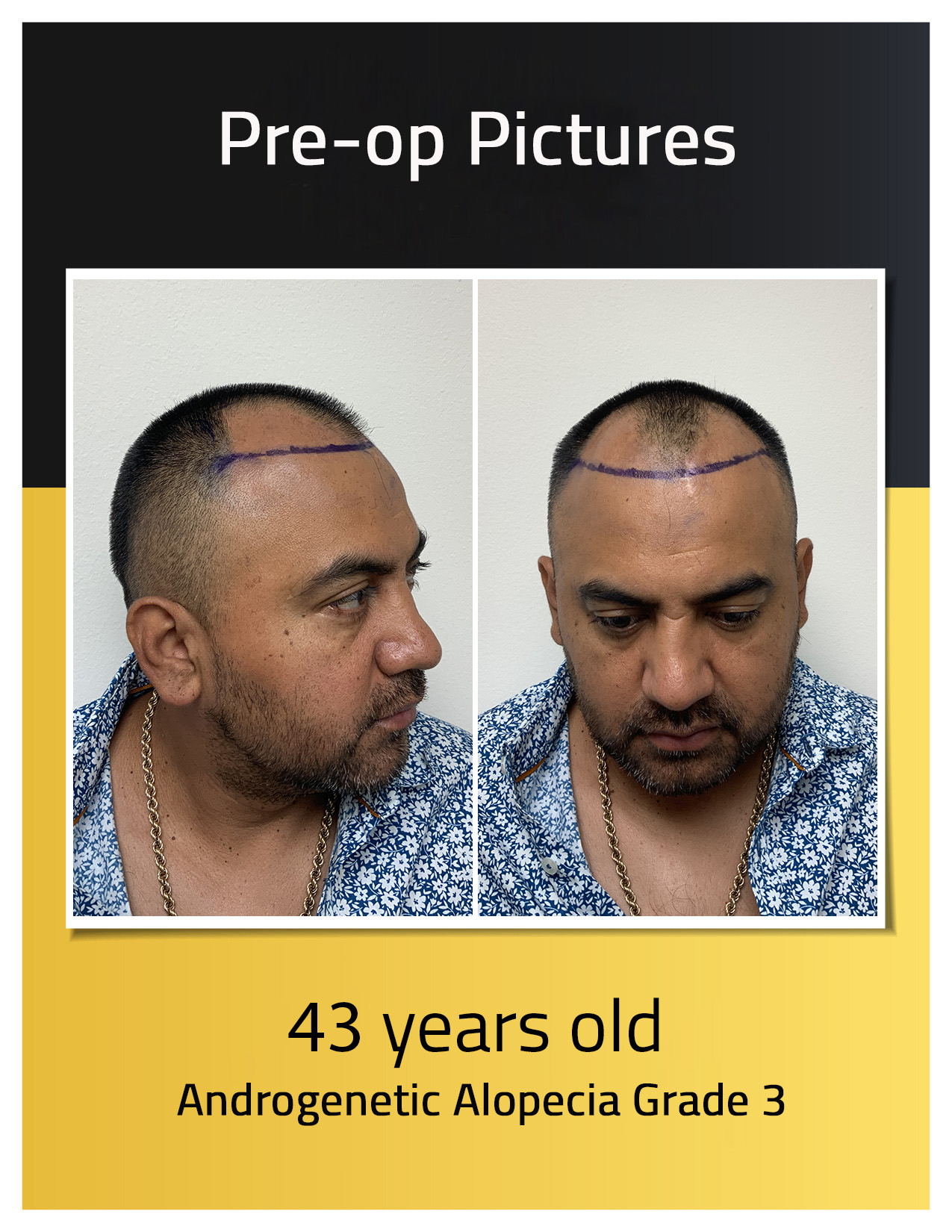 Fotos preoperatorias del trasplante de cabello de Angel Hidalgo