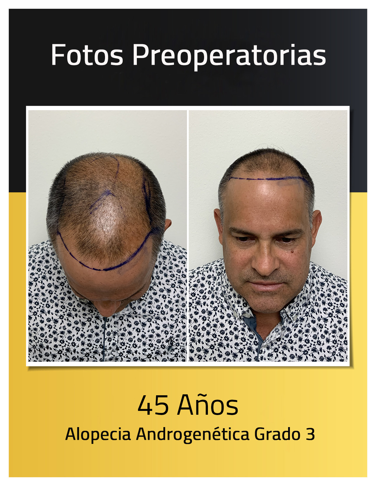 Fotos preoperatorias del trasplante capilar de Humberto Quílez