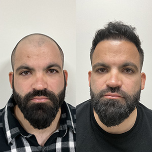 Ivan and His Hair Restoration Front View