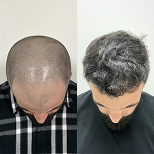 Ivan and His Hair Restoration Top view