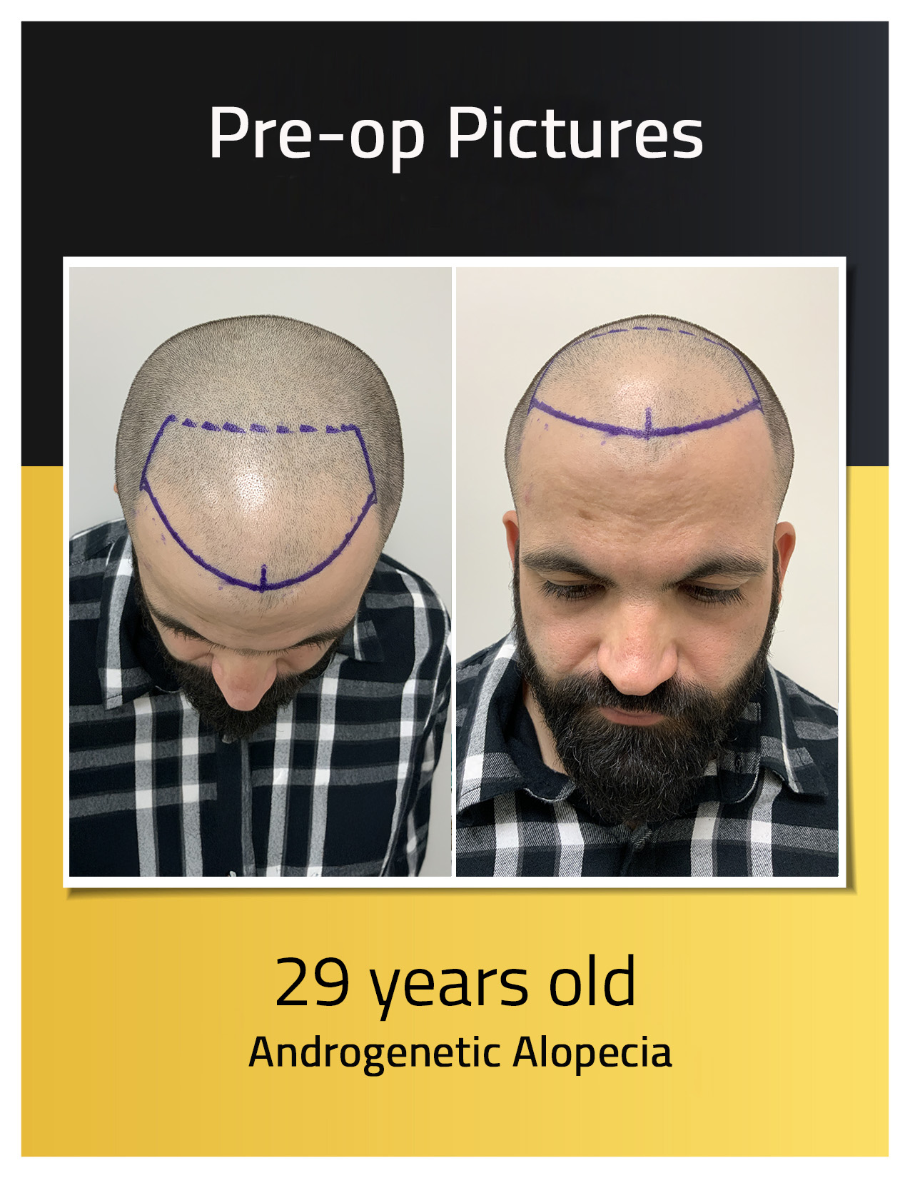 Ivan Hair transplant Pre-op photos