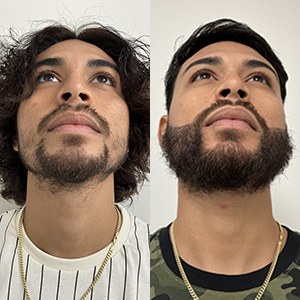 Beard Transplant before and after