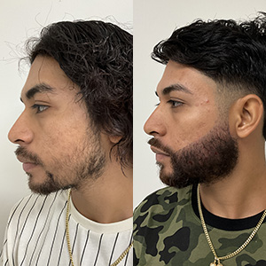 Beard Transplant before and after