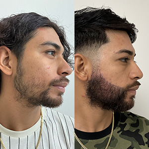 Beard Transplant before and after