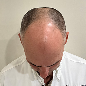 José Luis before hair transplant photo