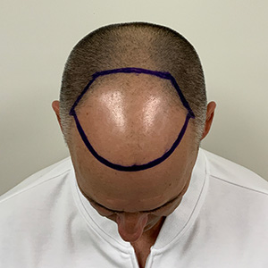 José Luis hair transplant surgery-day photo