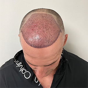 José Luis hair transplant 1-day-post-op photo