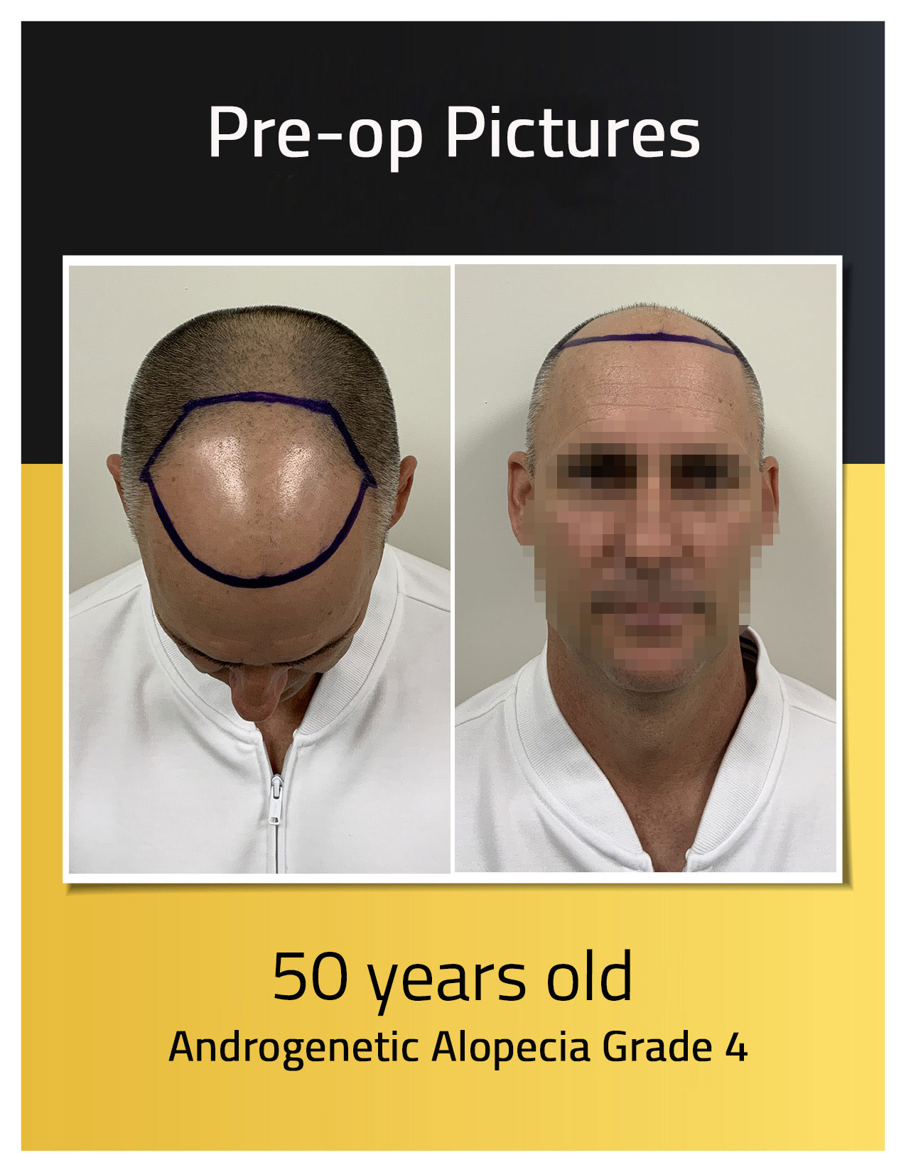 José Luis hair loss pre-op photos