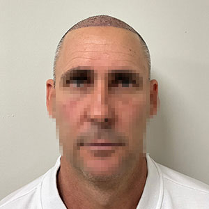 José Luis hair transplant 1 week after photo