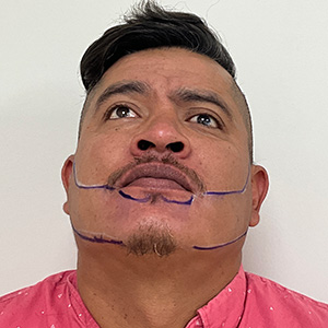 Juan Carlos Beard transplant design phase front view