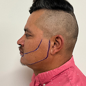 Juan Carlos Beard transplant design phase left view