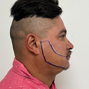 Patient Beard transplant design phase right view