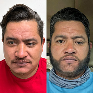 Patient Juan Carlos Transplant before and after front view