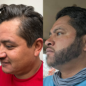 Patient Juan Carlos Transplant before and after left view