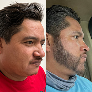 Patient Juan Carlos Beard Transplant before and after right side