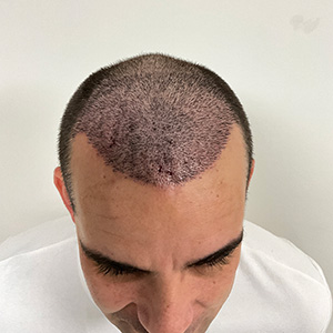 Loivwer patient: 1 week after hair transplant surgery photo