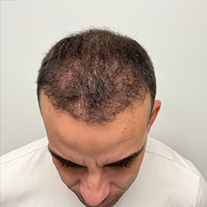 Loivwer patient: 4 months after hair transplant surgery photo